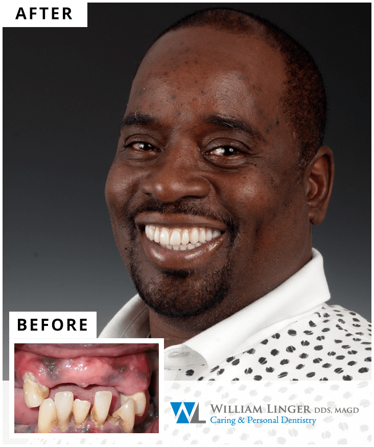 Dr. William Linger Dental Implants Charlotte NC